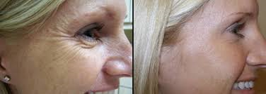 PlexR Soft Surgery facelift zonder snijden of hechtingen, ooglidcorrectie zonder snijden, Plexr teveel slappe huid verwijderen, rokersrimpels verwijderen, botox, Betaalbaar mooier, Laser, harmony XL, eindhoven, advanced skin care, betaalbaar mooier, pigment, vaatjes, littekens, acne, vlekjes, plekjes, lichte huid, donkere huid, getinte huid, huidverbetering, huidverjonging, hyaluronzuur, elastine, collageen, laserbehandeling, goedkoop, aanbieding, zomeractie, beharing, ontharing, permanent, tatoeage, tattoo, plexr, botox, kwaliteit, laser, alma laser, alma, CE geregistreerd, FDA, IPL, Lichttherapie, lasertherapie, huidtherapeut, huidspecialist, huidbehandeling, huid, bobbelig, strak, jong, oud, putjes, acnelittekens, gaaf, glad, openingstijden, telefoon, email, afspraak, prijzen, prijslijst, lichaamsbehandeling, lichaam, gelaat, decolleté, rug, armen, benen, billen, buik, lipo, ultrasone cavitatie, brabant, noord-brantant, goedkoop en goede kwaliteit. mooi, peeling, pHformula, peelings, Botox, Azzalure, bocouture, frons, kraaienpootjes, migraine, transpiratie, rimpels verwijderen, ooglid correctie, facelift, liquid facelift, Betaalbaar mooier, hoofdpijn, migraine, stoppen met tandenknarsen, een mooie lach door de gummysmile, nooit meer natte oksels, weg met zweten, geurloos zweten, anti transpiratie